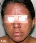 darier's disease