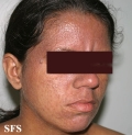 darier's disease