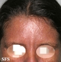 darier's disease