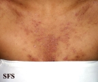 darier's disease
