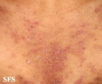 darier's disease