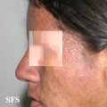 darier's disease