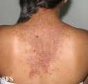 darier's disease