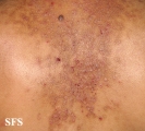 darier's disease