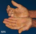 darier's disease