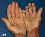 darier's disease