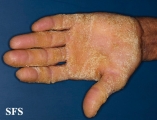 darier's disease
