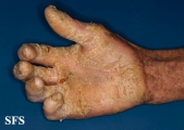darier's disease