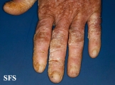 darier's disease