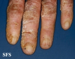 darier's disease
