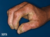 darier's disease