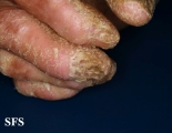 darier's disease