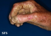 darier's disease