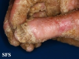 darier's disease