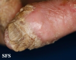 darier's disease
