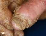 darier's disease