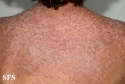 darier's disease