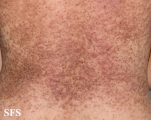 darier's disease