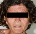 darier's disease