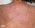 darier's disease