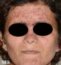 darier's disease