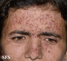 darier's disease