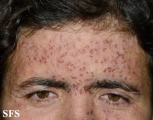 darier's disease