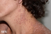 darier's disease