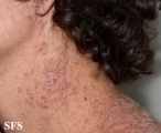 darier's disease
