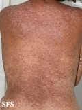 darier's disease