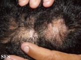 pseudopelade