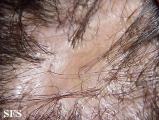 pseudopelade