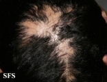 pseudopelade