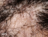 pseudopelade