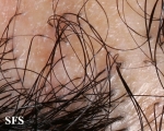 pseudopelade