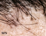 pseudopelade