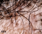 pseudopelade