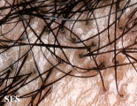 pseudopelade
