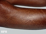 ichthyosis-acquired ichthyosis-clofazimine