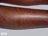 ichthyosis-acquired ichthyosis-clofazimine