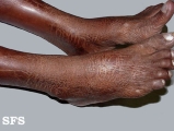 ichthyosis-acquired ichthyosis-clofazimine