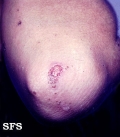epidermolysis bullosa simplex