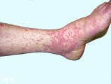 allergic vasculitis