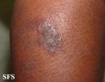 lichen simplex