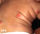 xanthogranuloma juvenile