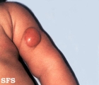 xanthogranuloma juvenile