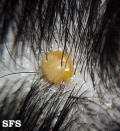 xanthogranuloma juvenile