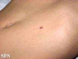 xanthogranuloma juvenile