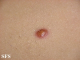 xanthogranuloma juvenile