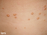 xanthogranuloma juvenile
